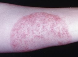 Ringworm: MedlinePlus Medical Encyclopedia