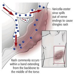 Does shingles occur in children?