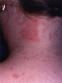 What causes a red circle rash on the chest?