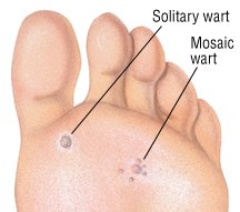 What are the different types of warts?