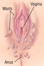 Hpv of the vulva