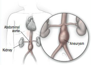 Abdominal aortic aneurysm