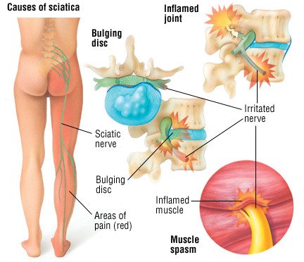 Nerve pain sciatic Types of