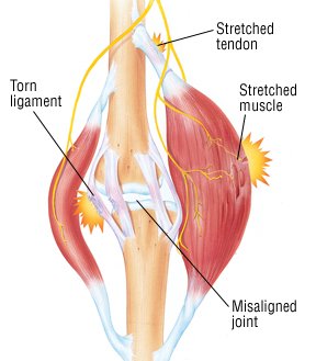 Thigh Muscle Strains 57