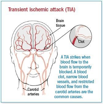 Transient ischemic attack (TIA)