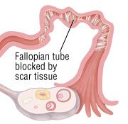 Pelvic Inflammatory Disease (PID)