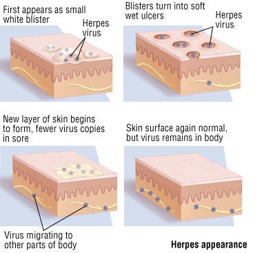 Herpes genital symptoms