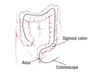 Colonoscopy