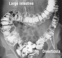 Diverticulosis and diverticulitis