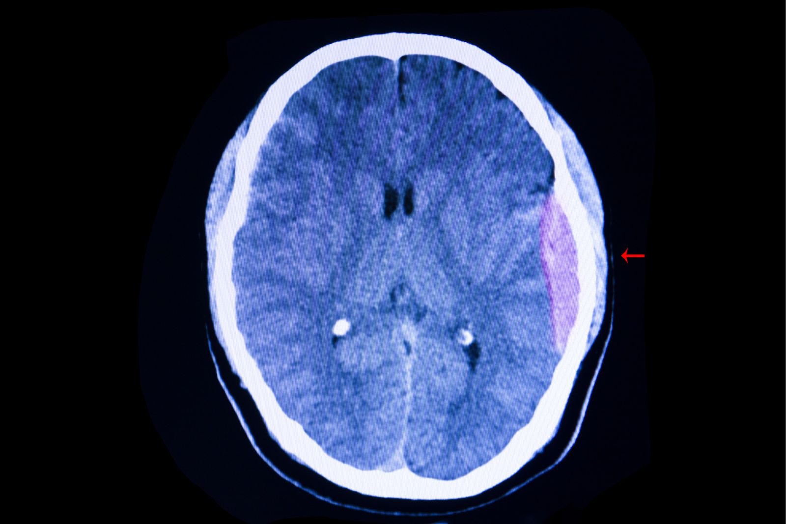 Head injury In adults