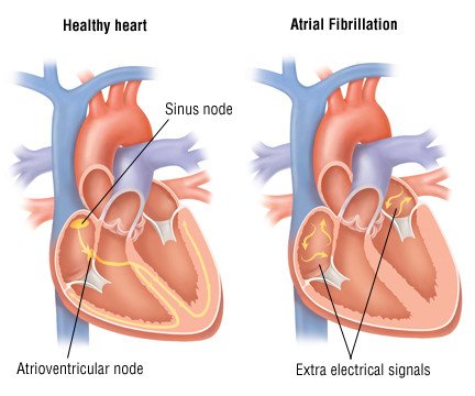 Atrial Guide: Causes, Symptoms and Treatment