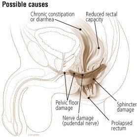 Fecal incontinence