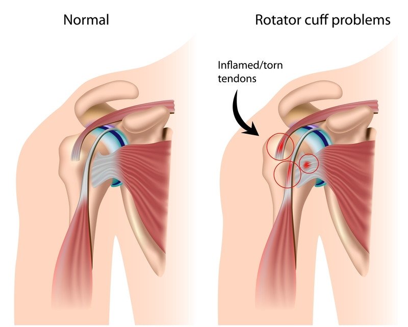 Common Wrestling Aches, Pains and Injuries