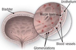 Interstitial Cystitis