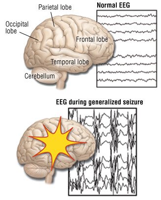 Generalized Seizures (Grand Mal Seizures)