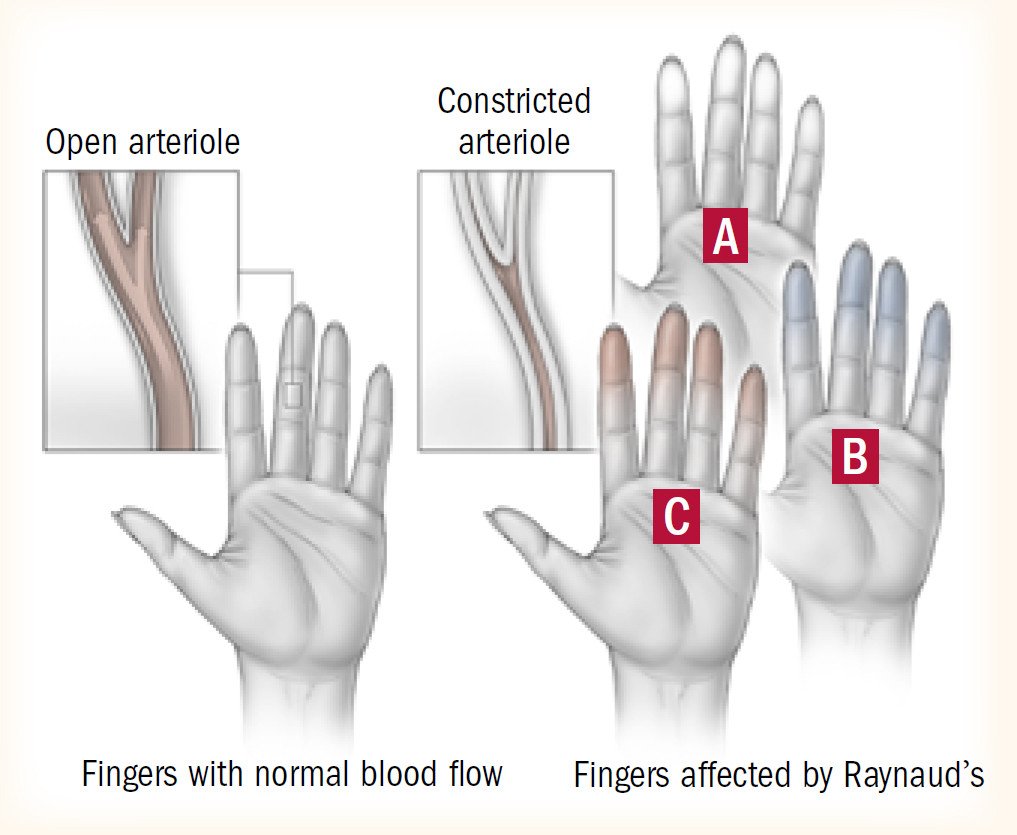 Raynaud's phenomenon