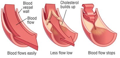 High Cholesterol (Hypercholesterolemia)