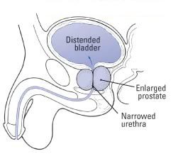 Enlarged Prostate (Benign Prostatic Hyperplasia)