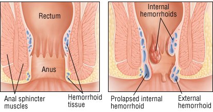 Pain inside anal hole