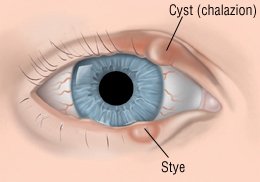 What causes styes?