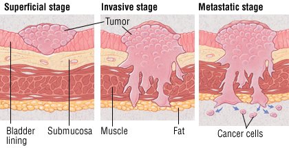 Bladder Cancer Guide: Causes, Symptoms and Treatment Options