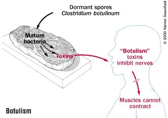 botulism guide causes symptoms and treatment options