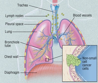 lung cancer cells diagram