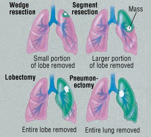 Small Cell Carcinomas: Causes, Diagnosis and Treatment