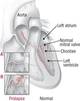 Mitral Valve Prolapse