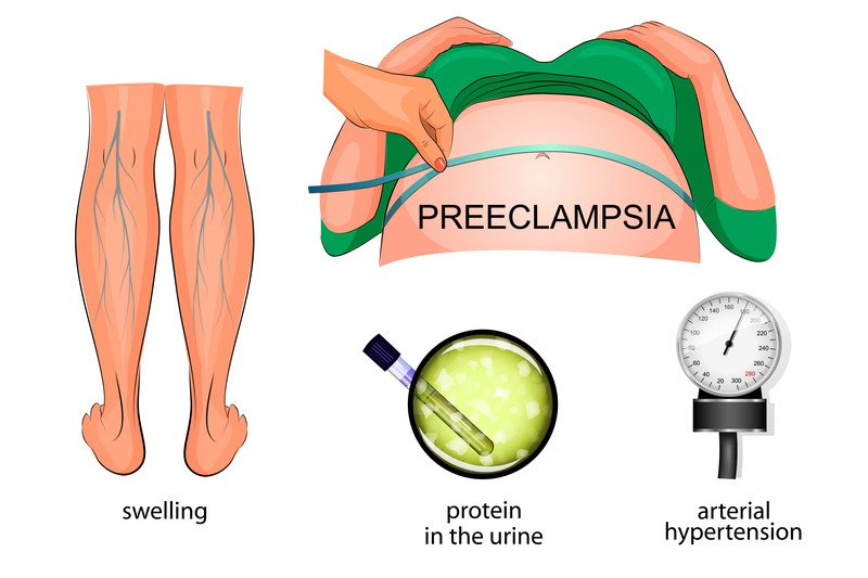 Preeclampsia And Eclampsia