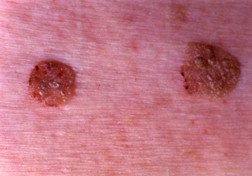 Seborrheic keratoses