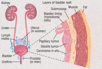bladder warts symptoms)