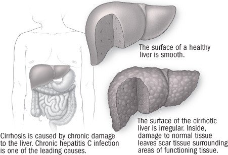 Cirrhosis