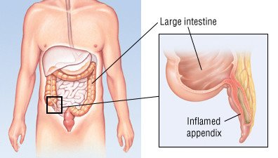 Appendicitis Guide: Causes, Symptoms and Treatment Options