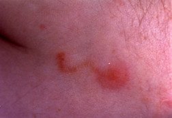 Scabies Guide Causes Symptoms And Treatment Options
