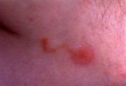 Scabies Rash Toddler