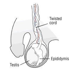 Testicular Torsion