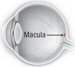 Macular degeneration