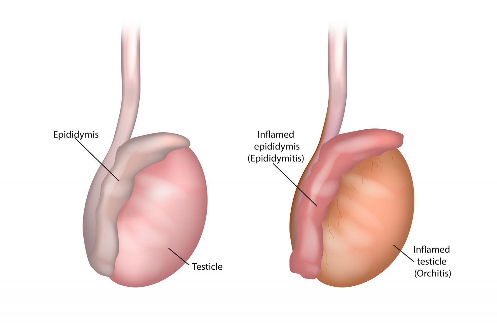 Epididymitis and orchitis