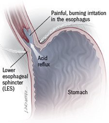 Tablet what if stuck do in throat to antibiotic tablet