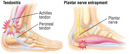 sharp pain in heel bone
