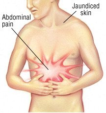 Hepatobiliary Pancreatic Surgery Bile Duct Cancer Cholangiocarcinoma
