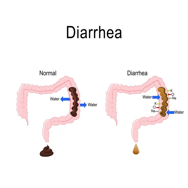 Diarrhea Guide Causes Symptoms And, How To Stop Watery Stools
