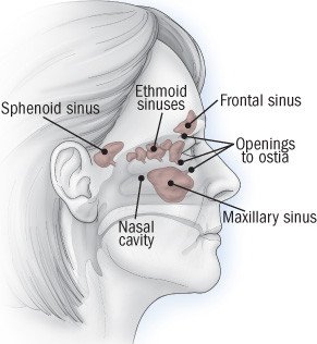 Acute sinusitis