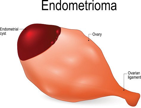 Endometriosis Guide: Causes, Symptoms and Treatment Options