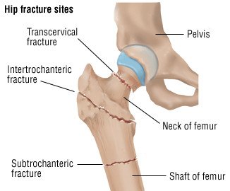 Leg Fracture