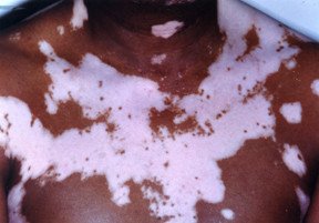 Vitiligo