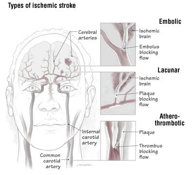 Lacunar stroke