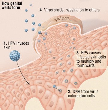 hpv on neck wart)