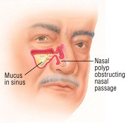 Remedy home nose polyps Nasal Polyps